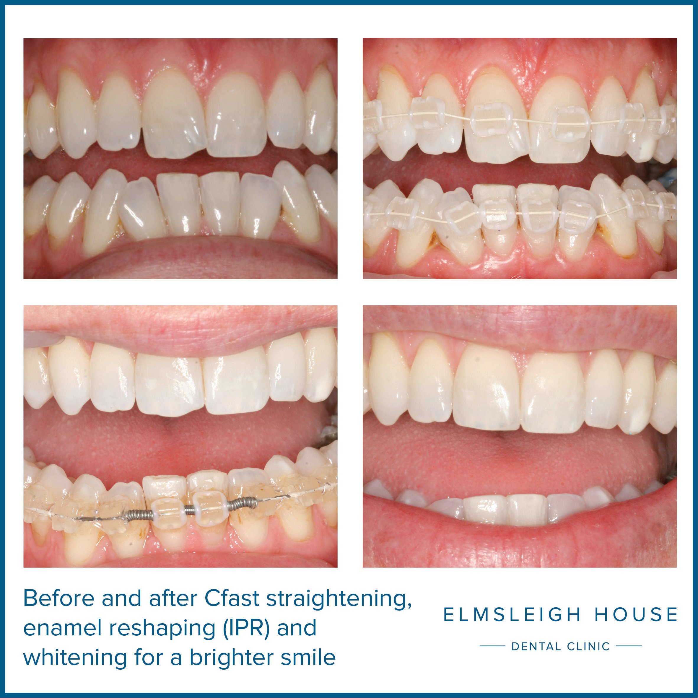 Cfast reshaping and whitening